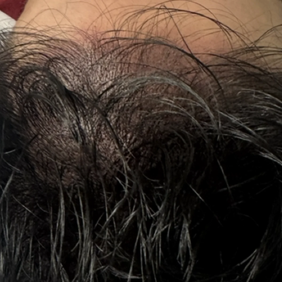 The same crown after treatment, reading noticeably denser