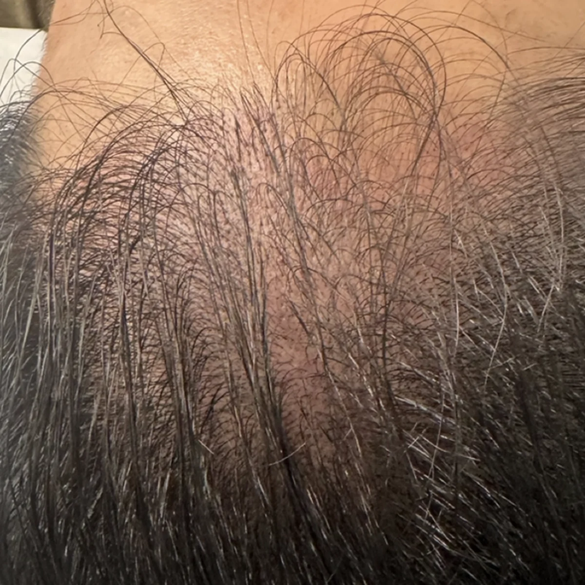A guest's crown before treatment, scalp visible through thinning hair