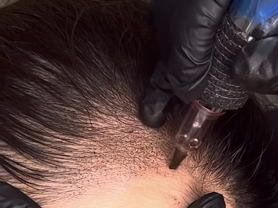 A gloved practitioner working along a guest's hairline with a micropigmentation pen, pigment already stippled into the scalp
